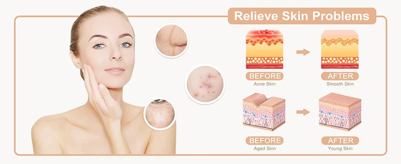 Larinas High Frequency Facial Wand
